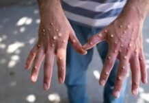 മങ്കി പോക്സ്: സംശയിച്ചിരുന്ന ആറ് കേസുകളും നെഗറ്റീവ്